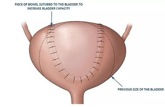 Augmentation Cystoplasty Surgery In India Cost Hospitals And Doctor